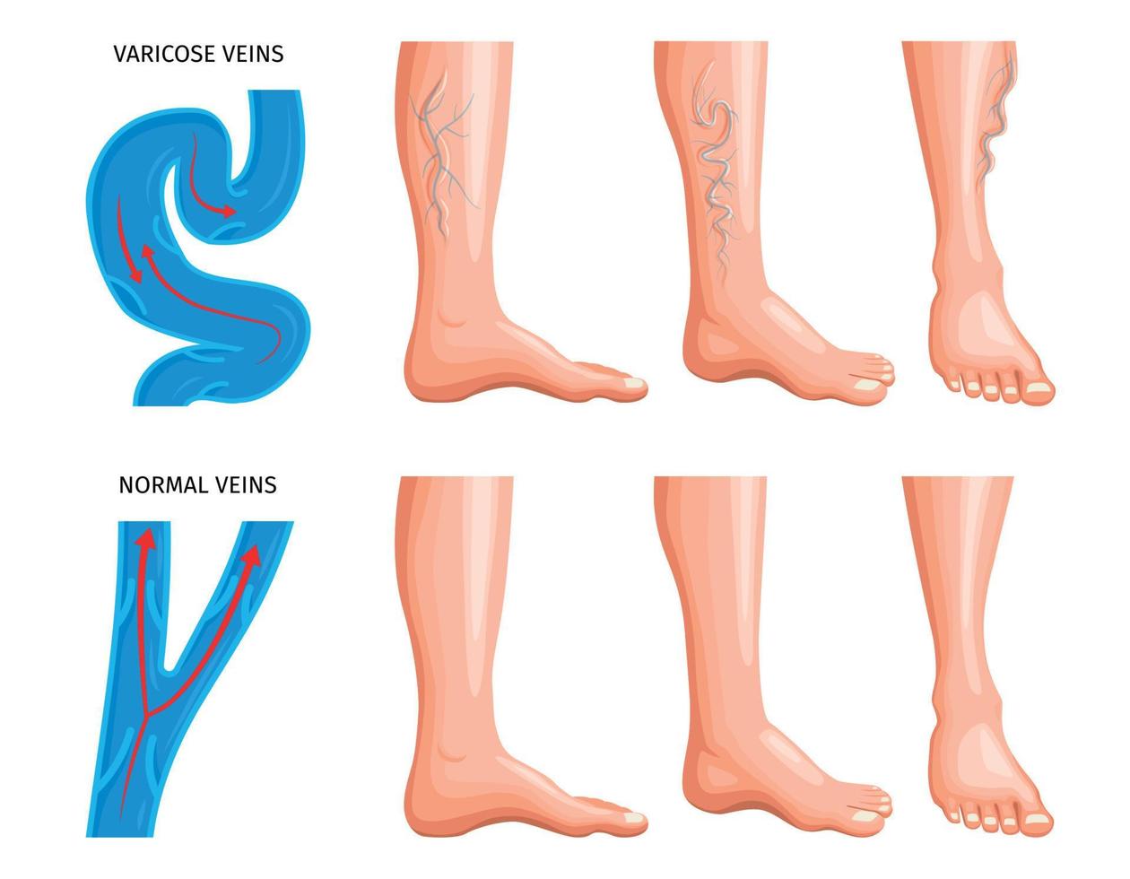 ensemble réaliste d'anatomie des varices vecteur