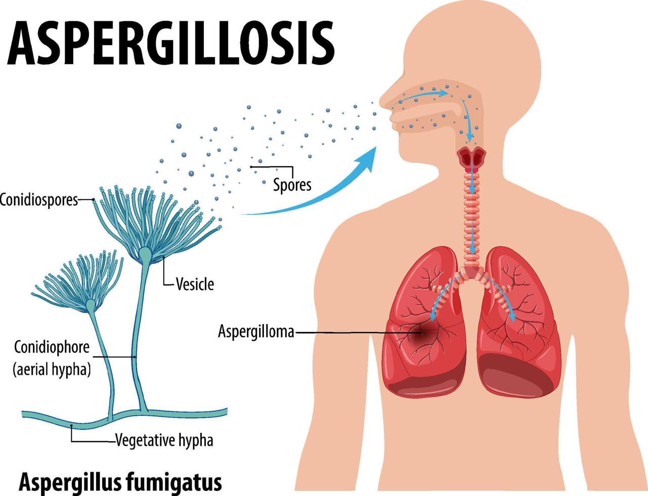 schéma montrant une infection à aspergillus vecteur