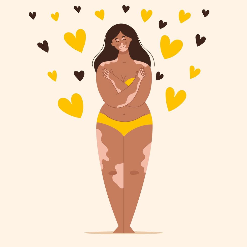 belle jeune femme brune atteinte de vitiligo en maillot de bain jaune. caractéristiques de la peau, mélanine. amour pour votre corps, positivité du corps. illustration vectorielle vecteur
