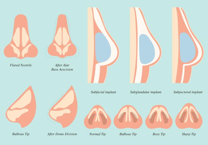 Vecteurs d'opération de chirurgie vecteur