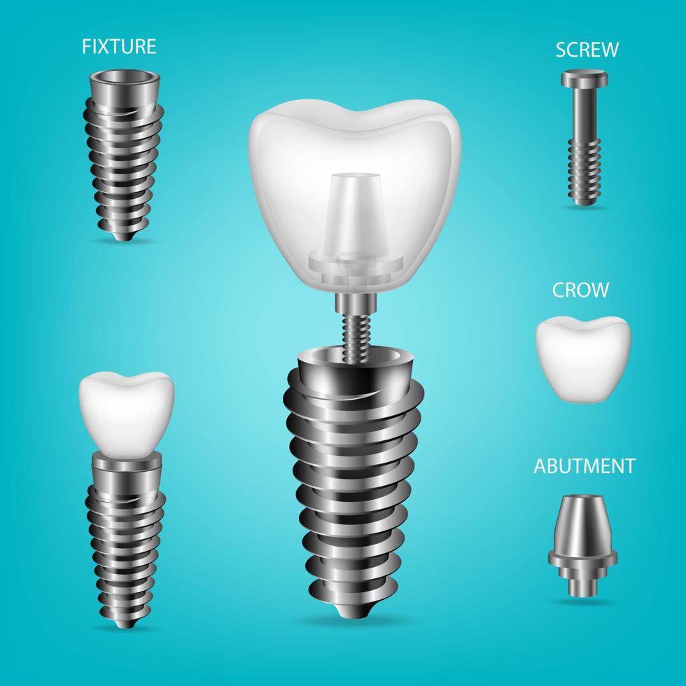 vecteur réaliste, ensemble 3d d'implants dentaires. éléments structurels d'un implant dentaire, isolés.