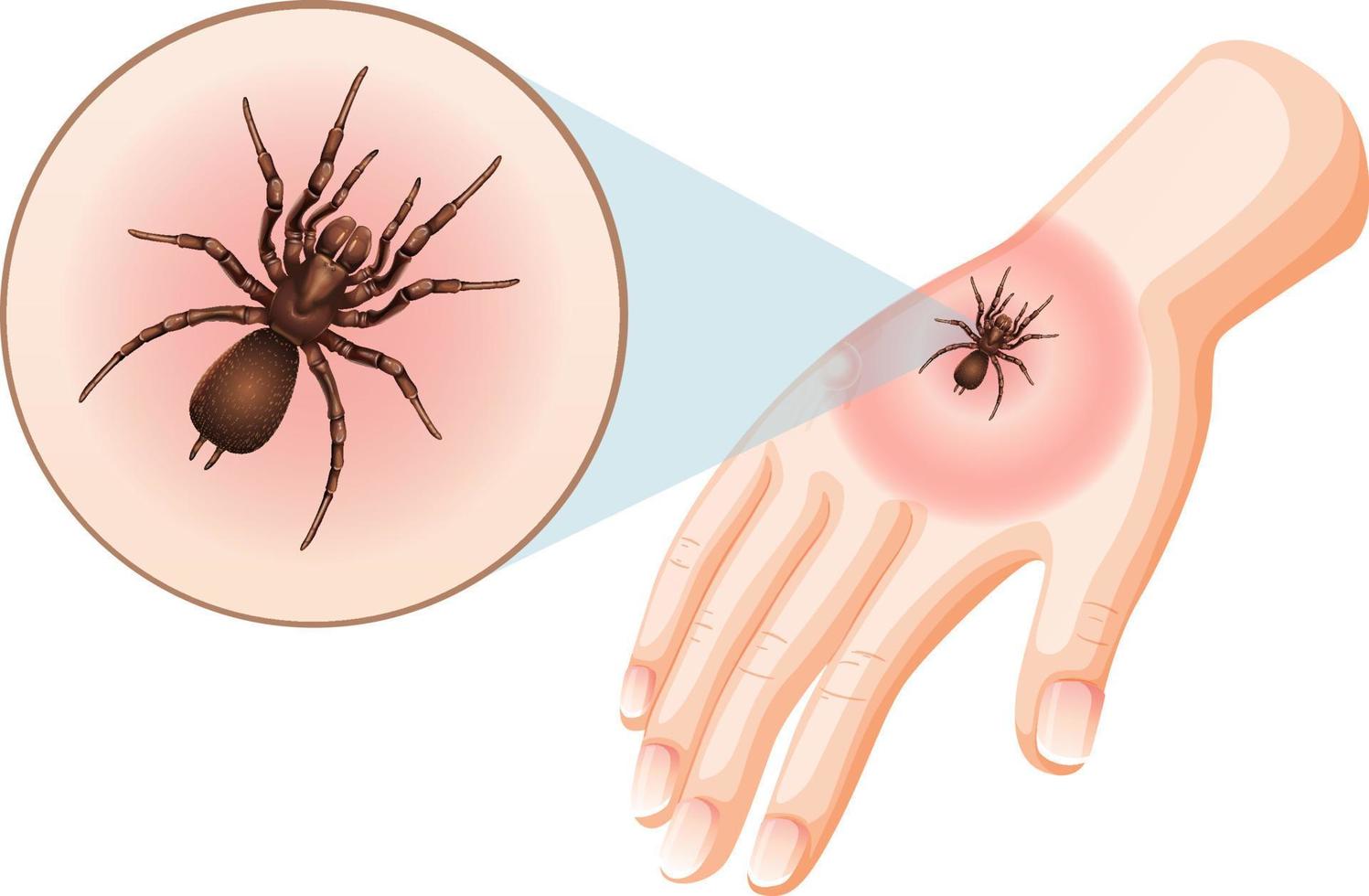 les morsures d'araignées piquent sur la peau vecteur