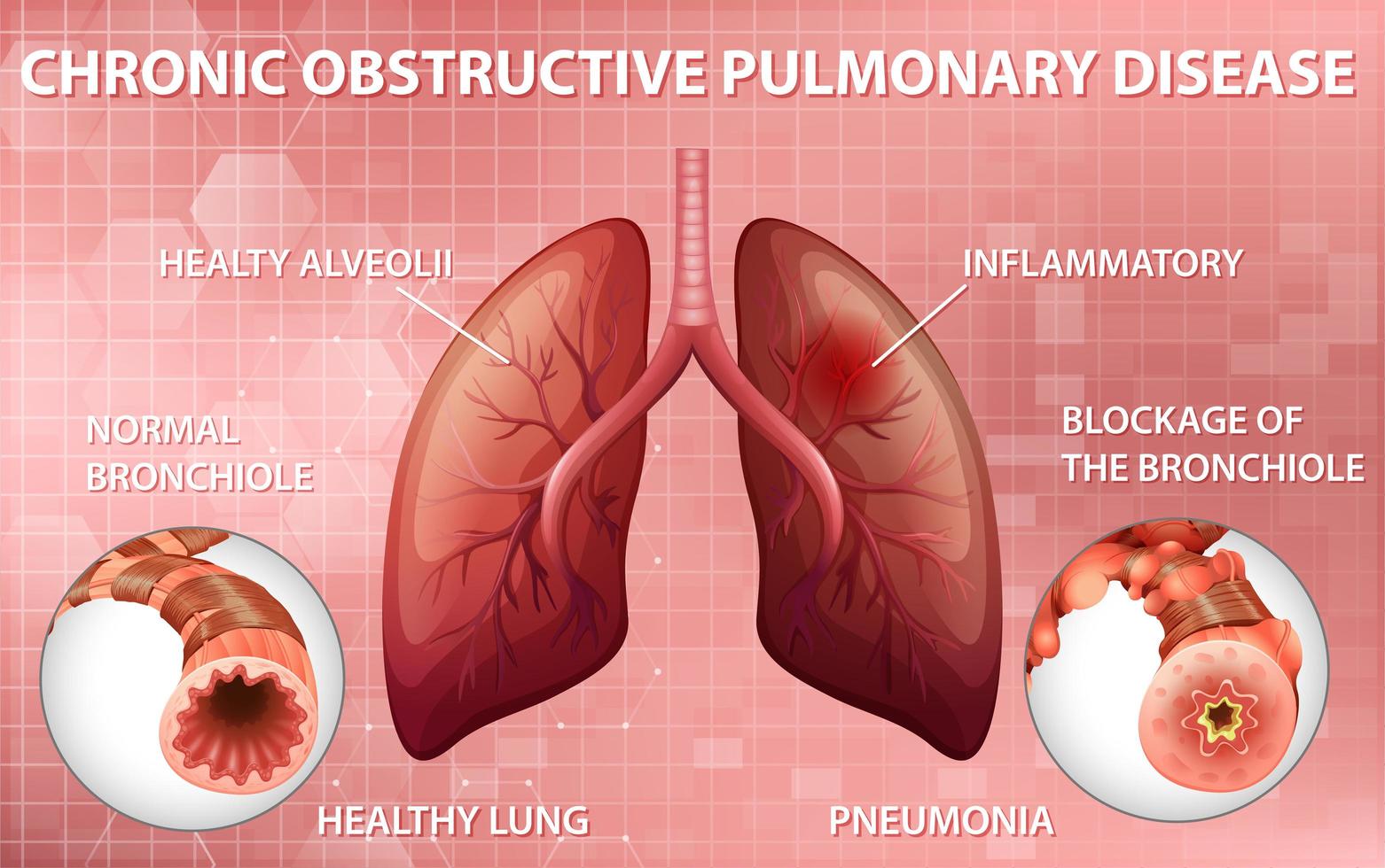 diagramme éducatif de la maladie pulmonaire obstructive chronique vecteur