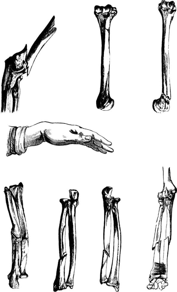 os fracturés, illustration vintage. vecteur