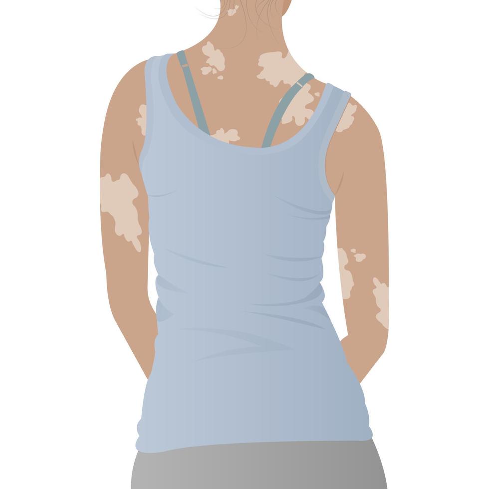 femme avec vitiligo sur la peau. concept de diversité de beauté, corps positif, acceptation de soi, sensibilisation aux maladies chroniques de la peau, illustration vecteur