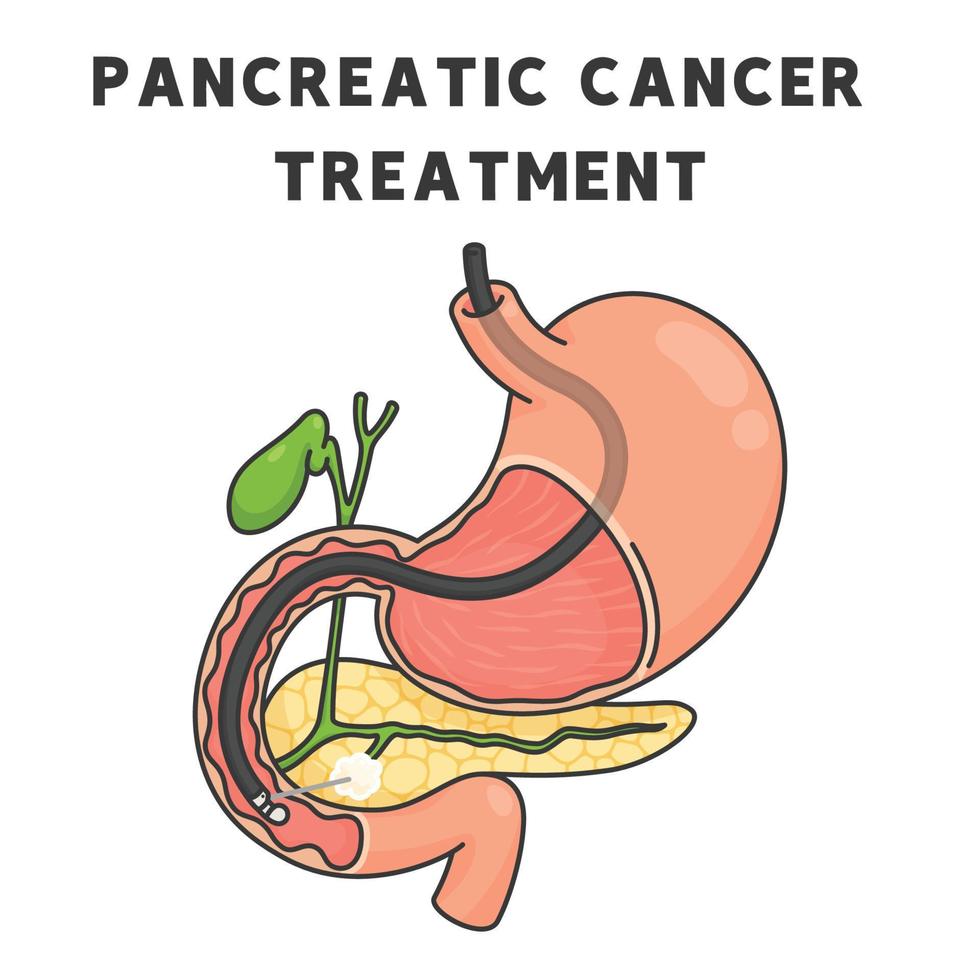 tableau de traitement du cancer du pancréas dans le dessin animé de vecteur de doodle kawaii sujet scientifique