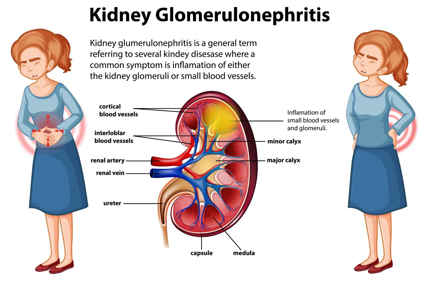 infographie médicale de la glomérulosclérose rénale vecteur