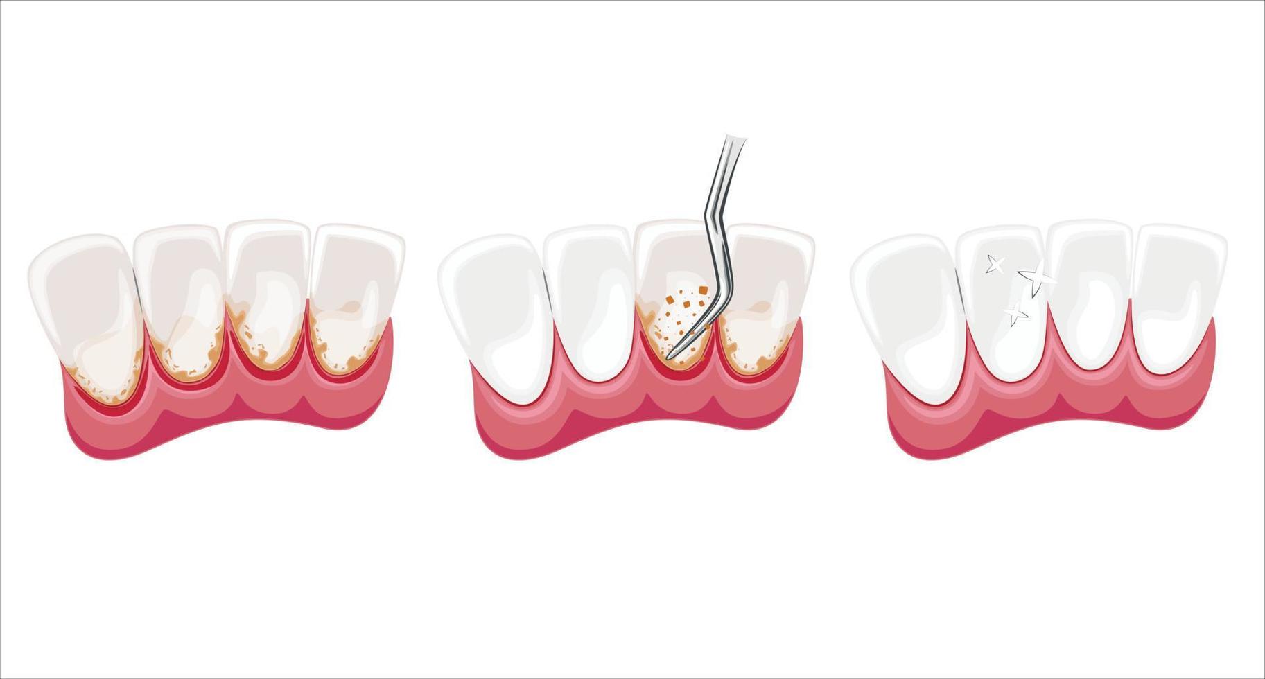 illustration de nettoyage des dents, dents saines, illustration vectorielle de dentiste, soins bucco-dentaires vecteur