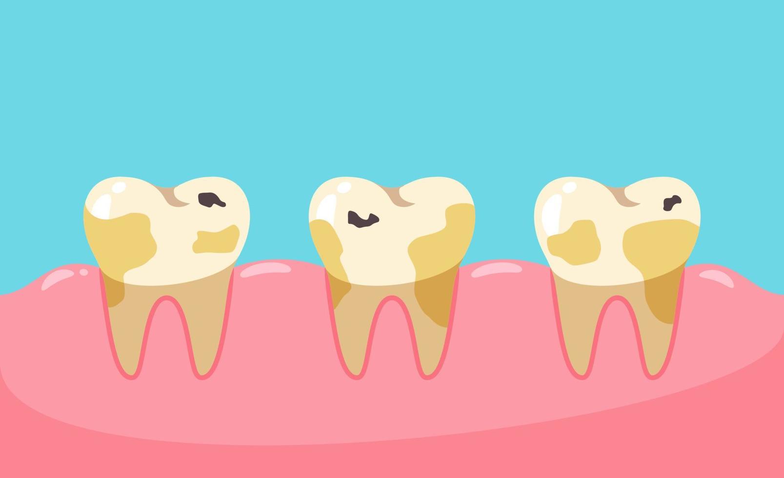 dents malsaines de vecteur. caries et plaque dentaire vecteur
