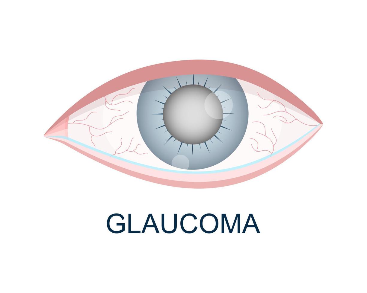 oeil avec vue rapprochée du glaucome. trouble, rougeur, globe oculaire aqueux. organe de vision humain avec des problèmes visuels vieillissants vecteur