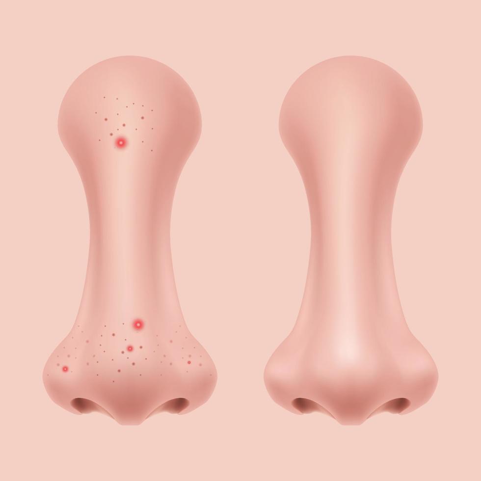 vue de face nez humain sur le visage illustration réaliste pour la médecine, isolé sur le vecteur de conception de fond blanc. partie du corps pour la biologie. nettoyage des pores, traitement de l'acné soins de la peau du visage, avant après.