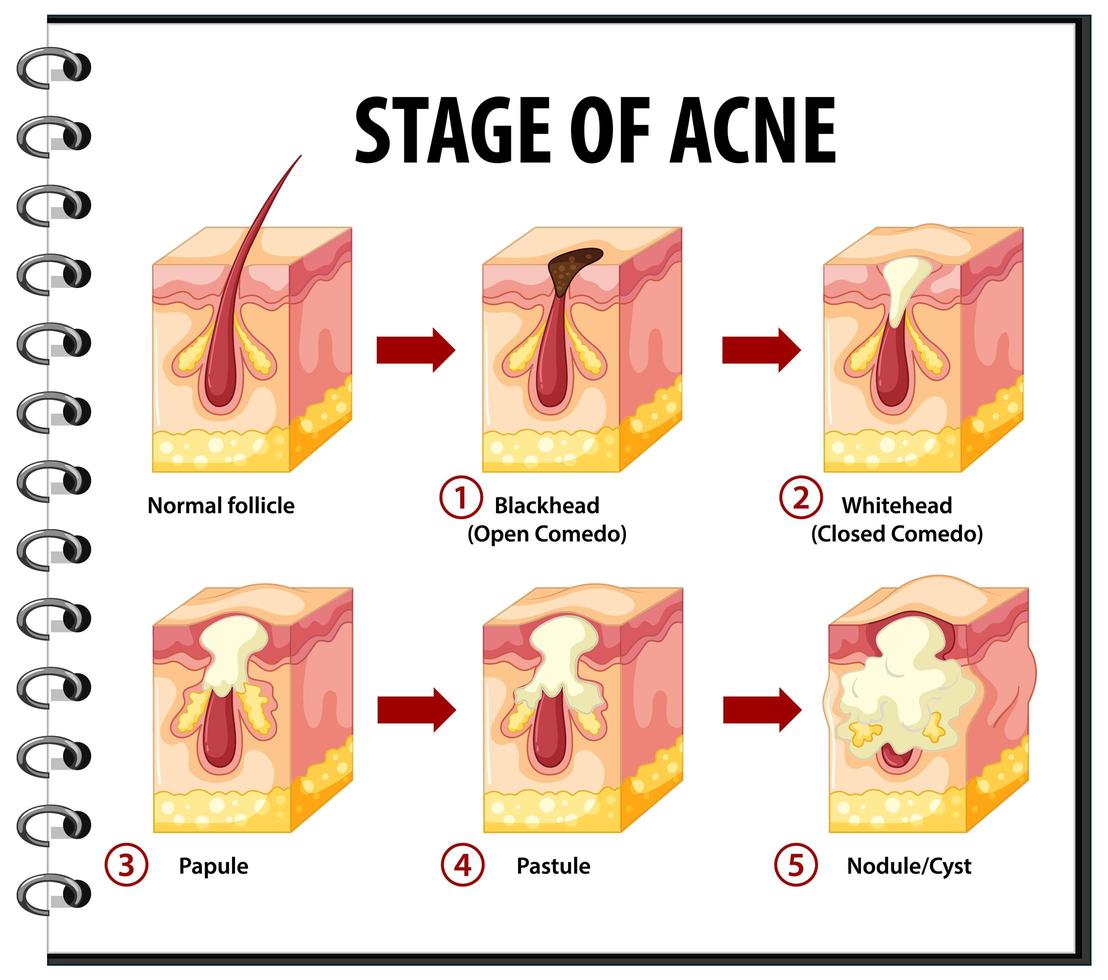 étapes de l'anatomie de l'acné de la peau vecteur