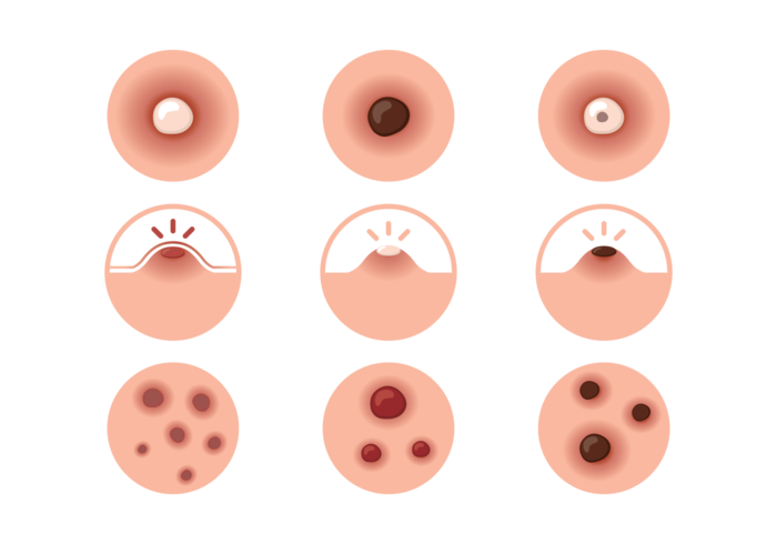 pimple icons vector