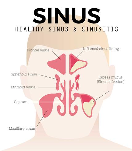 Vecteur gratuit de sinus et de sinusite