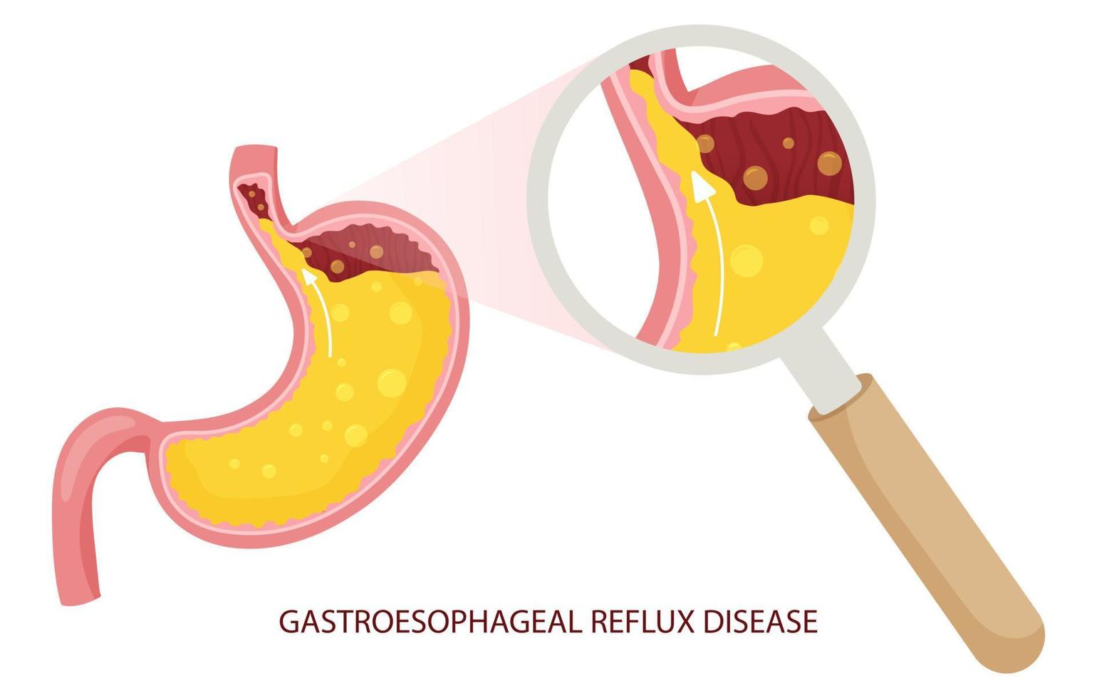 illustration de la maladie de reflux gastro-oesophagien sous la loupe vecteur