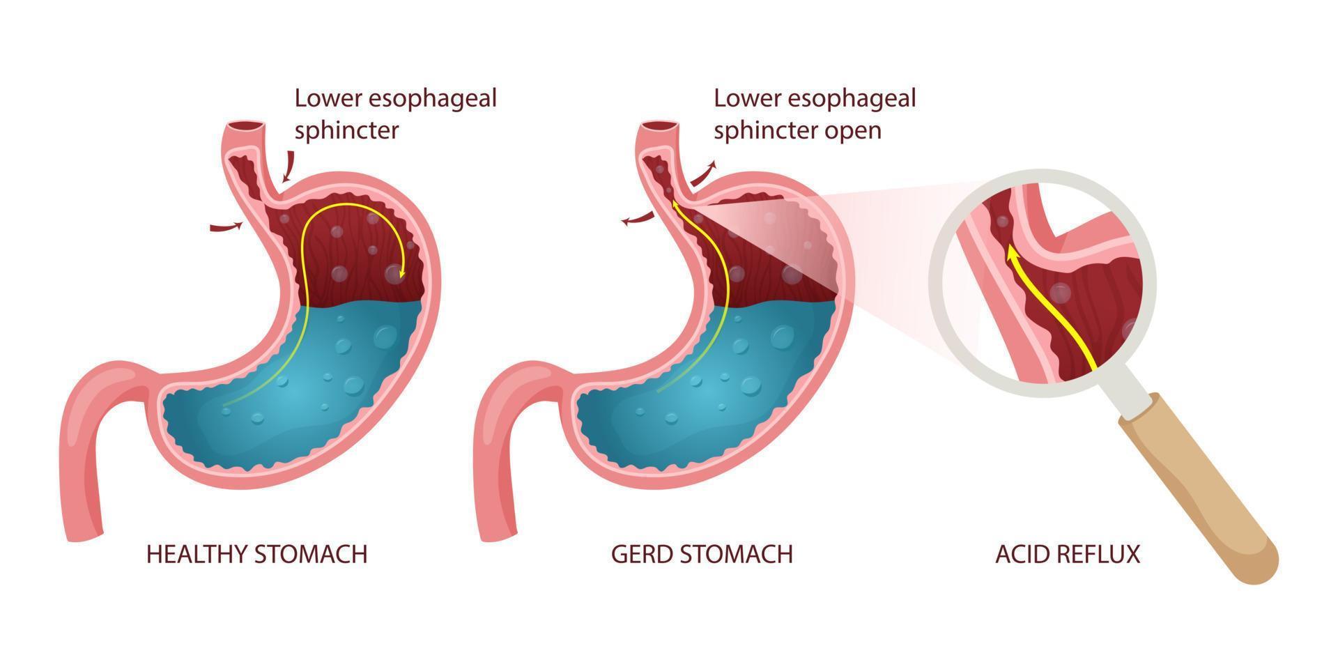 infographie de l'estomac et du RGO en bonne santé vecteur