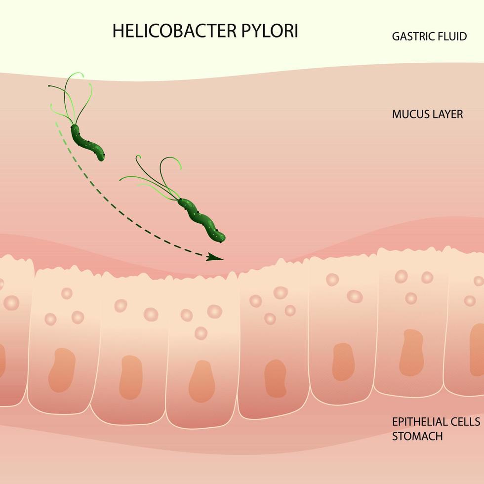 processus d'infection à helicobacter pylori dans l'estomac humain vecteur