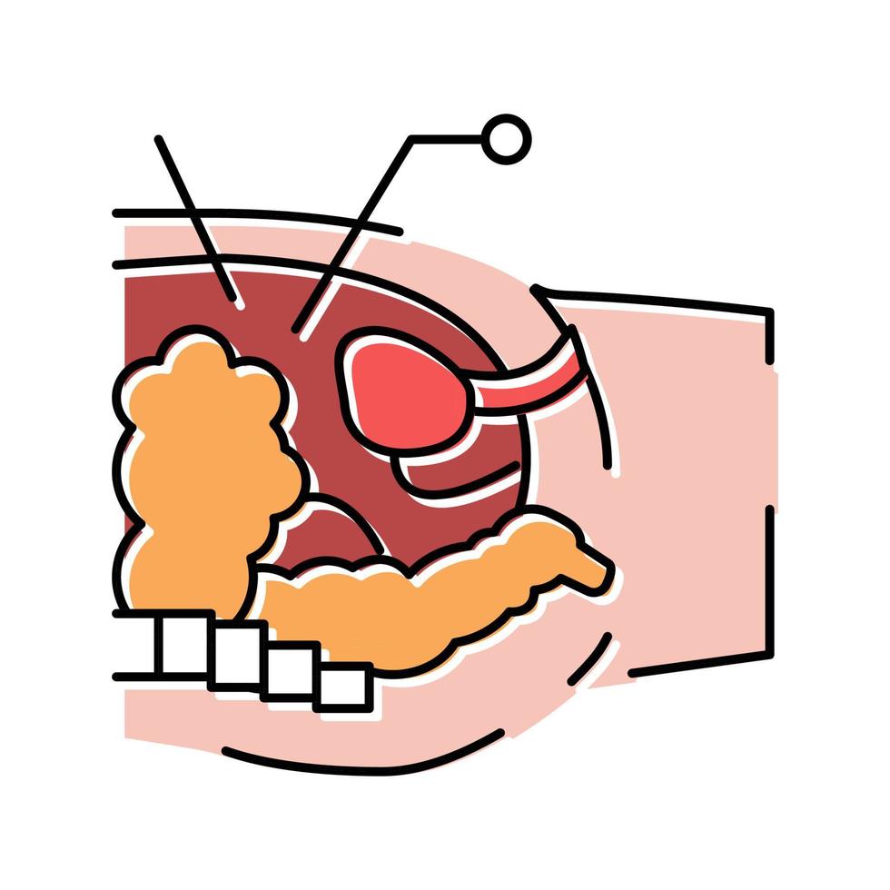illustration vectorielle de l'icône de couleur bariatrique du processus d'opération vecteur