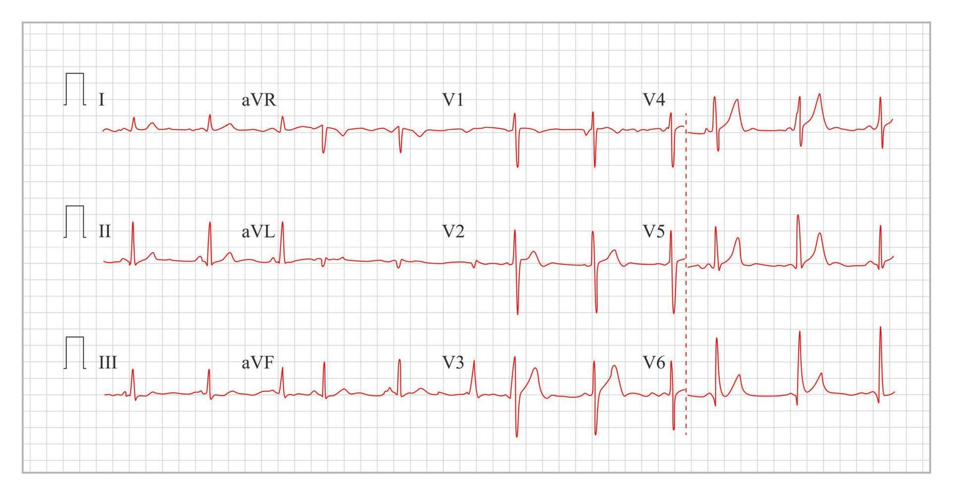 vecteur de diagramme de cardiogramme cardiaque.