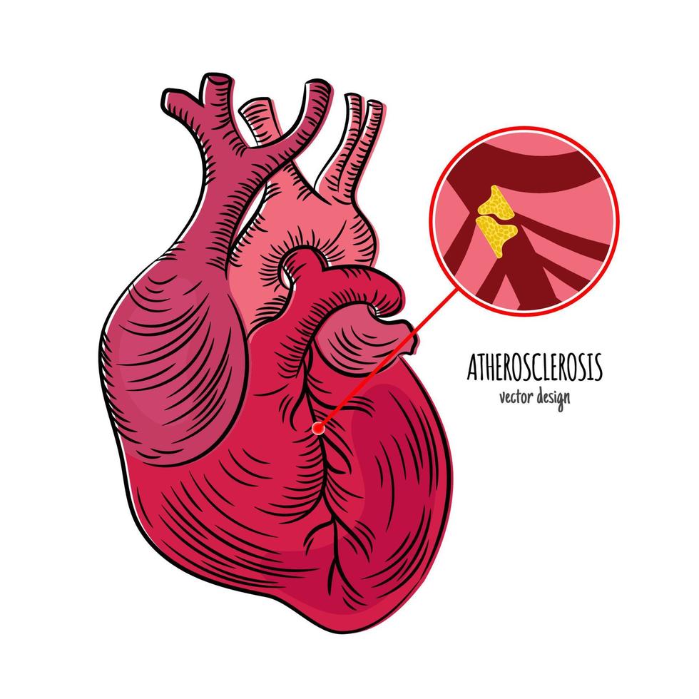 athérosclérose maladie chronique maladies médicament éducation diagramme vecteur