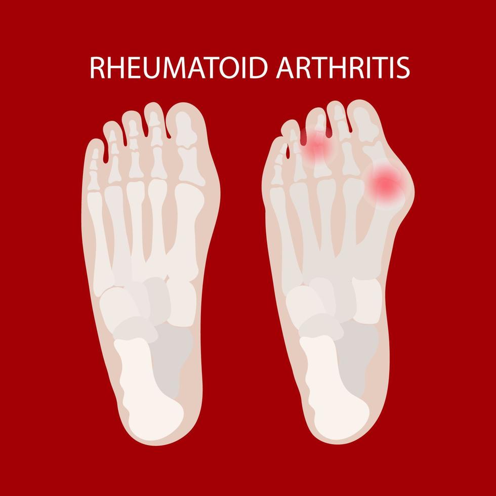 rhumatoïde jambe lésions arthrite éducatif médicament schème vecteur