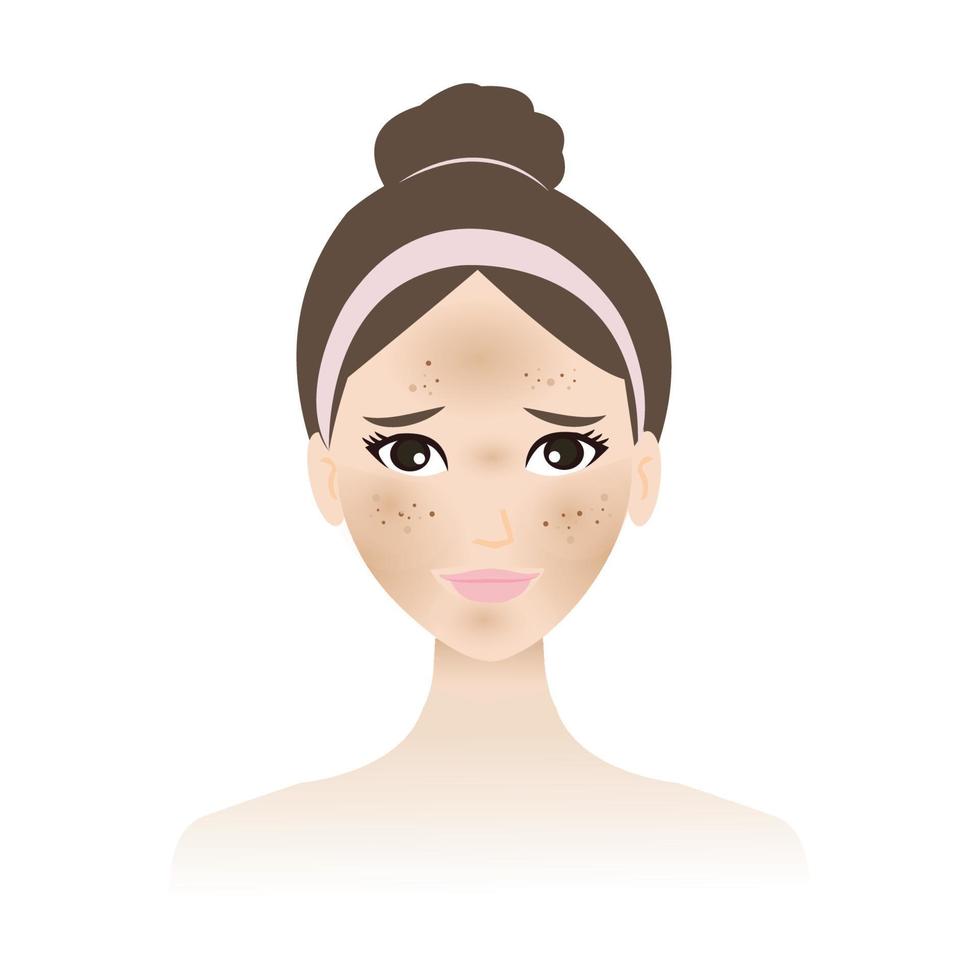 hyperpigmentation et mélasma est sur le femme visage vecteur isolé sur blanc Contexte. une inégal foncé marron et taches est sur le peau affronter, joues, nez, plus haut lèvre et front. peau problème concept.