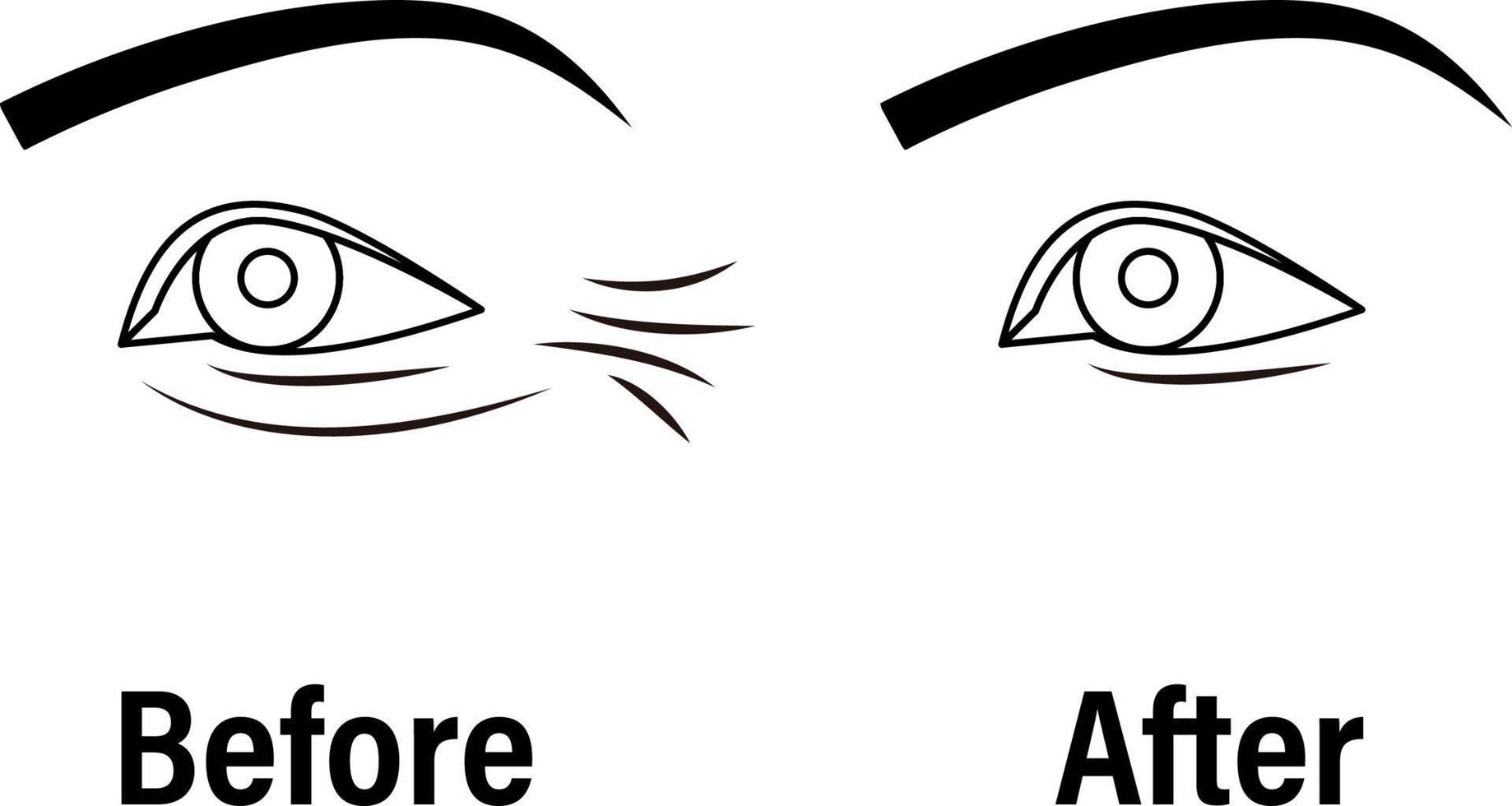 Icône de couleur d'injection de neurotoxine de pattes d'oie. injection anti-rides contour des yeux. réduction des rides. procédure cosmétique. rajeunissement du visage. illustration vectorielle isolée vecteur