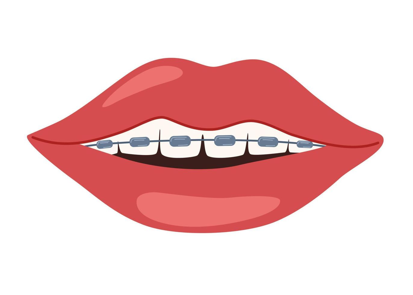 bouche avec un appareil dentaire sur dents. installation croisillons. correction de octet. dentisterie. orthodontie. installation croisillons. métal croisillons. tout droit dents. vecteur illustration