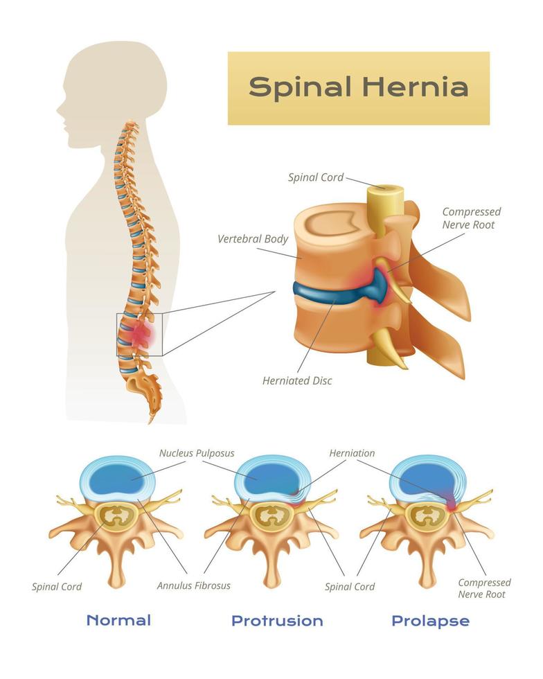 anatomie spinal hernie infographie vecteur