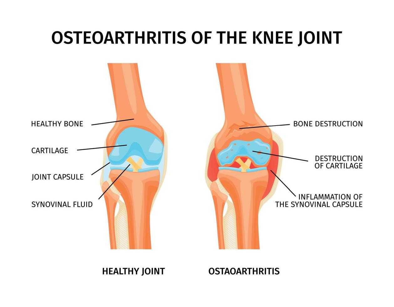 le genou mixte arthrose infographie vecteur