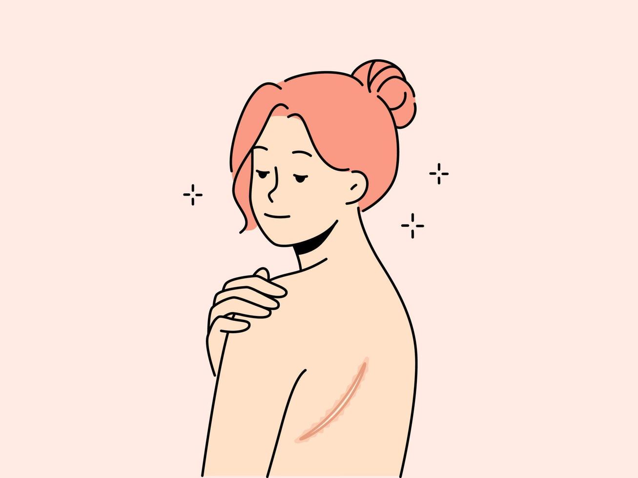 nu femme avec cicatrice sur dos. femelle démontrer marque ou blessure sur corps. peau imperfection. vecteur illustration.