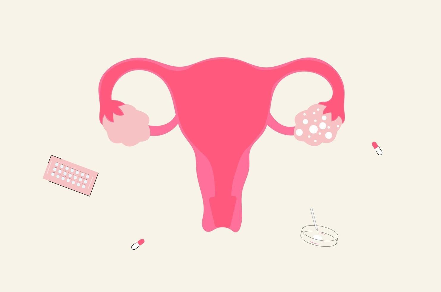 illustration vectorielle du syndrome des ovaires polykystiques ou pcos vecteur