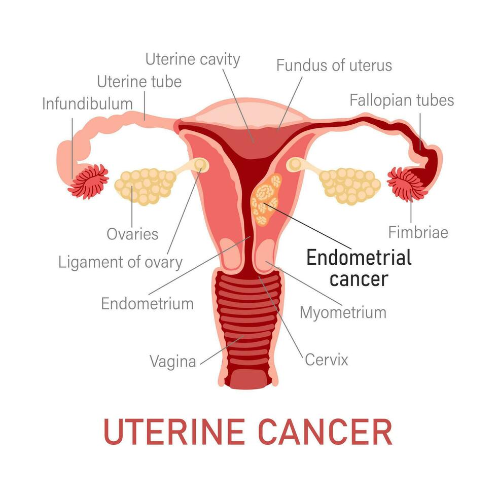 utérin cancer. maladies de le femelle reproducteur système. gynécologie. médical concept. infographie bannière. vecteur