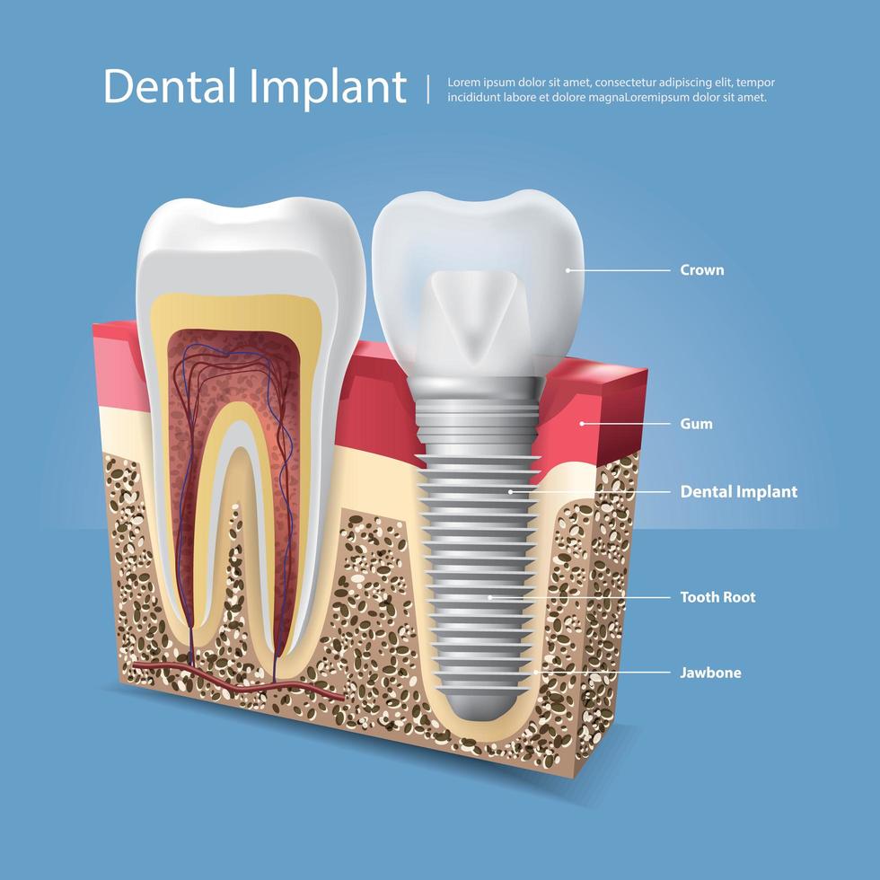 illustration vectorielle de dents humaines et implant dentaire vecteur