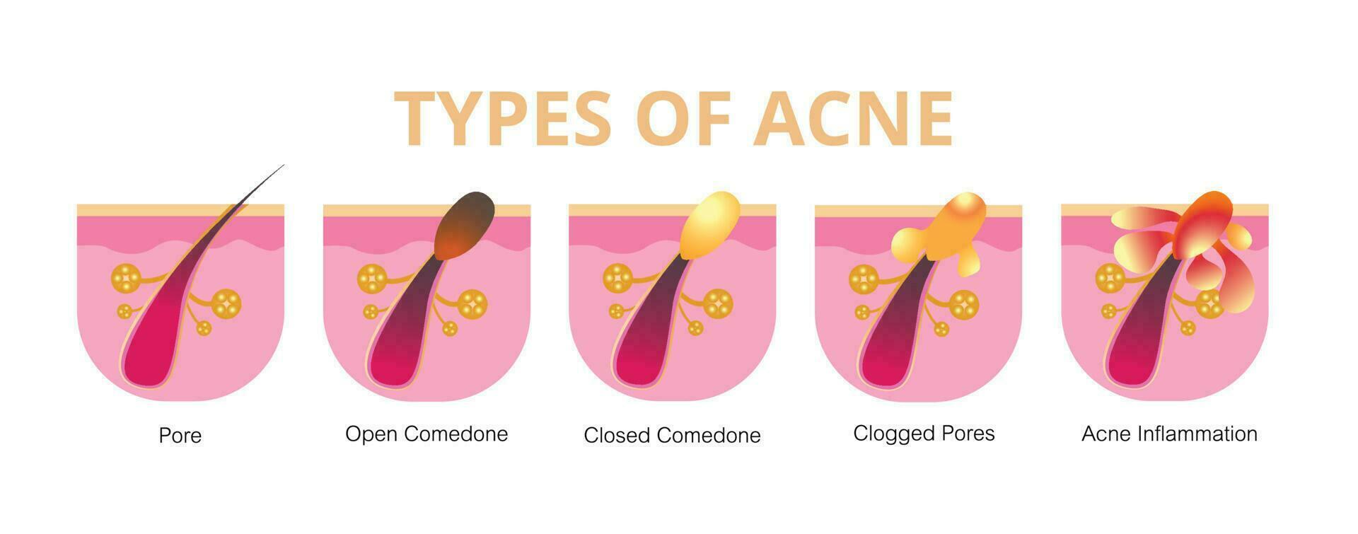 acné, étapes de développement, en bonne santé peau, vecteur conception