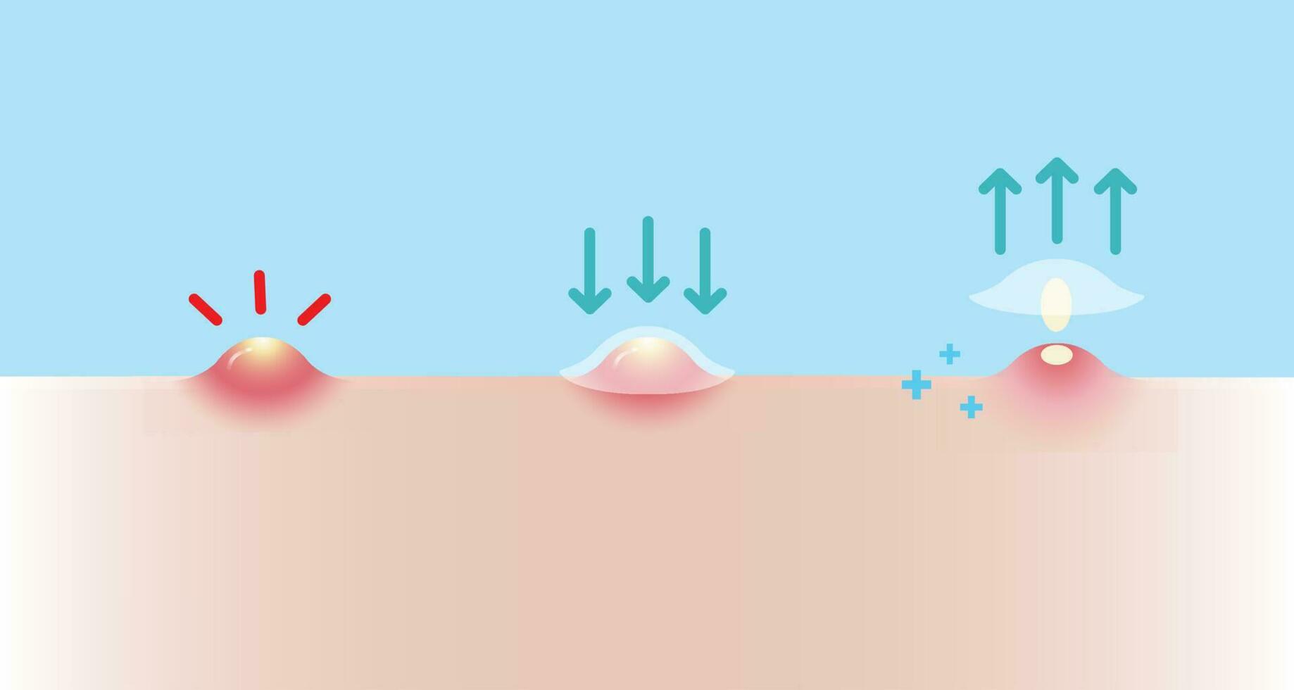 direction pour utilisation acné bouton pièce pour inflammatoire acné vecteur illustration sur bleu ciel Contexte. Comment à utiliser, étape de utilisation acné pièce absorbant pustule sur peau affronter. peau se soucier et beauté concept.