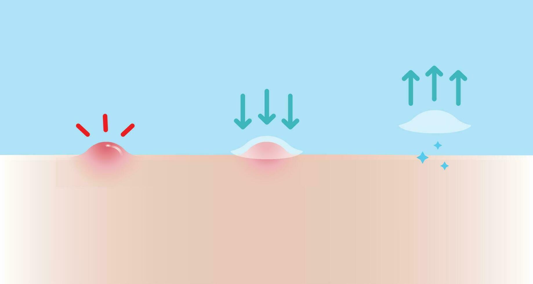 Comment à utilisation acné bouton pièce pour inflammatoire acné vecteur illustration sur bleu Contexte. étape de utiliser, direction pour utilisation acné pièce absorbant papule sur peau affronter. peau se soucier et beauté concept.