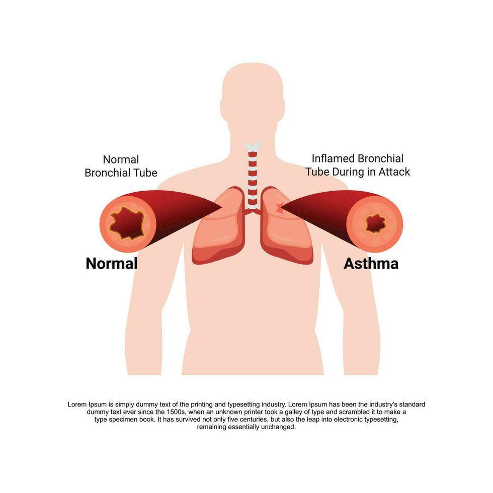 un asthmatique des bronches tube vecteur