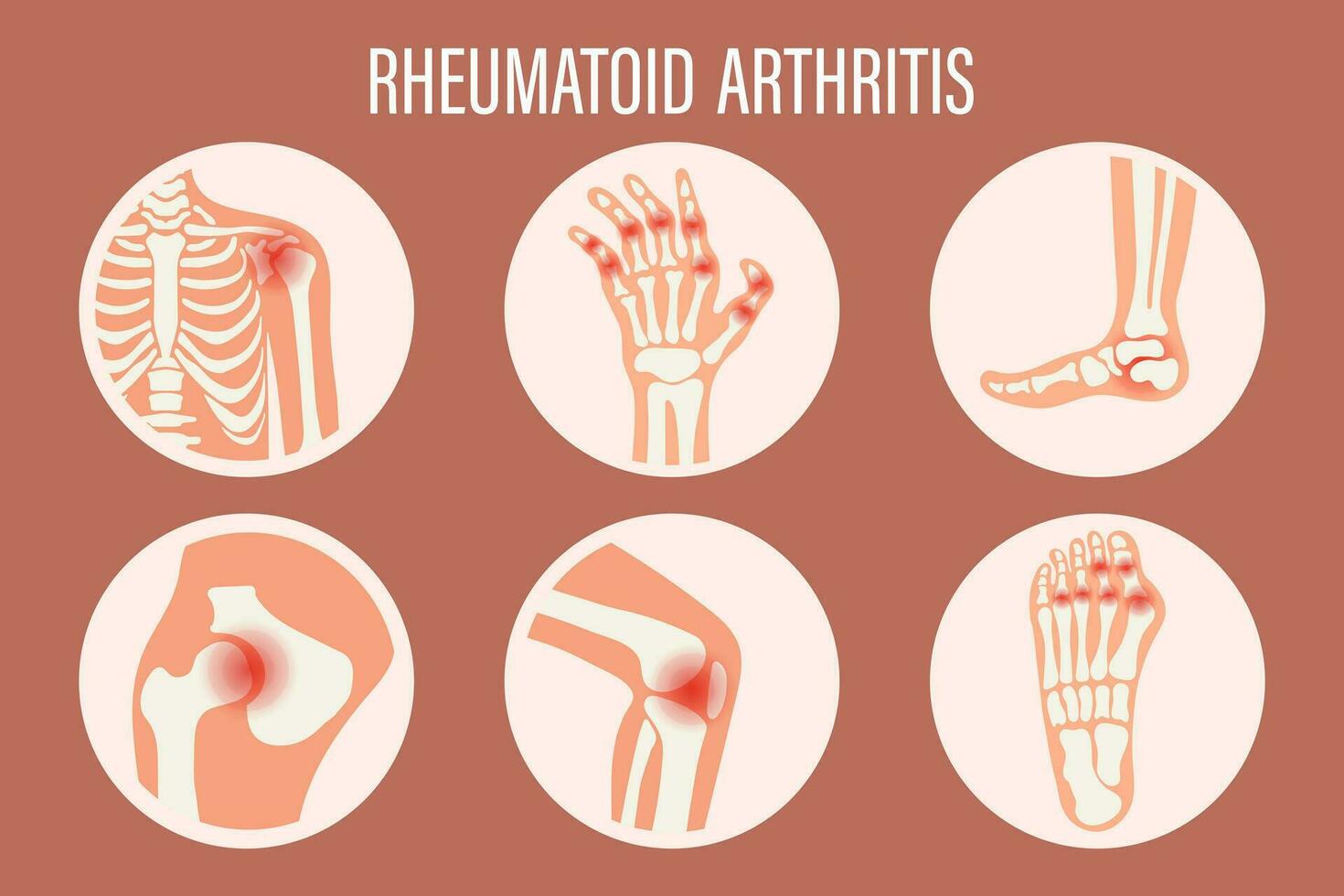 rhumatoïde arthrite Icônes. le genou articulation, épaule articulation, poignet articulation, hanche articulation, pied articulation. les types de arthrite. médical concept. vecteur