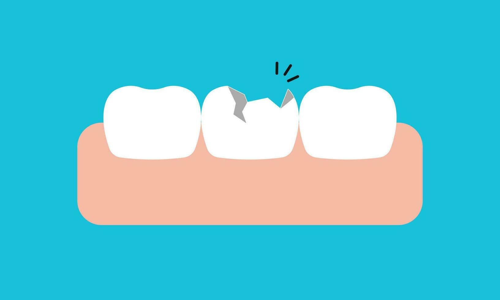 cassé blanc les dents et les gencives illustration vecteur conception sur bleu Contexte. dentaire se soucier concept.