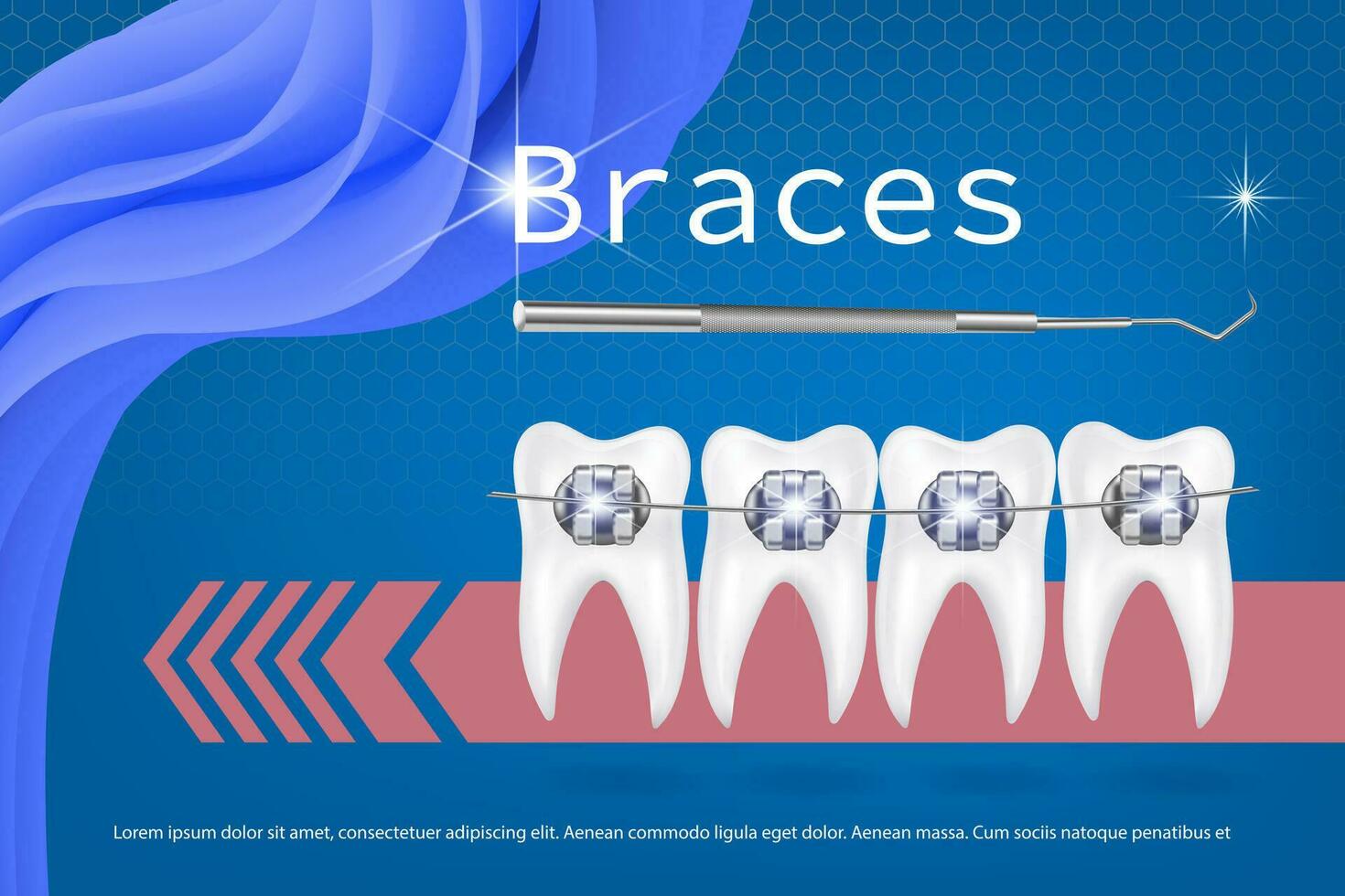 3d vecteur illustration, réaliste les dents avec un appareil dentaire plus haut et inférieur mâchoire. alignement de le mordre de dents, dentition avec croisillons, dentaire un appareil dentaire