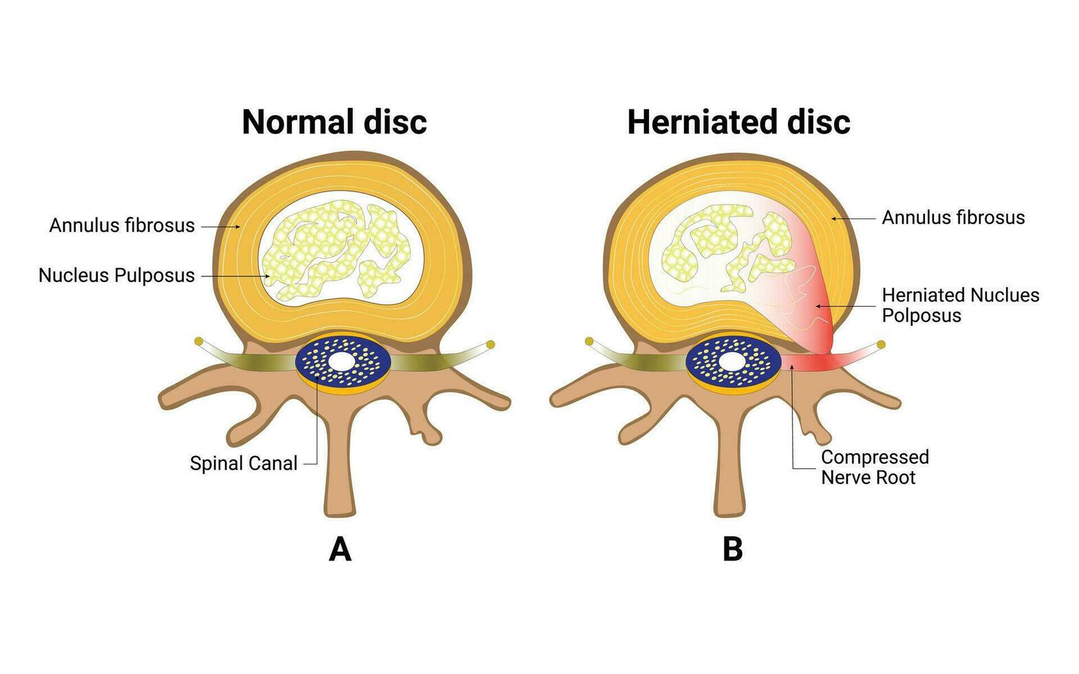 Ordinaire disque et hernie disque conception vecteur illustration