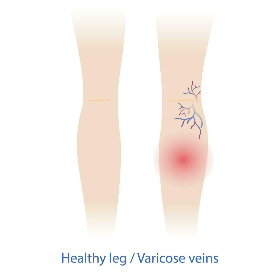 Comparaison de en bonne santé et variqueux veines sur le femme jambes vecteur illustration isolé sur blanc Contexte. variqueux et araignée veines sont gonflé, tordu et douleur, fabrication leur spectacle en dessous de le peau.