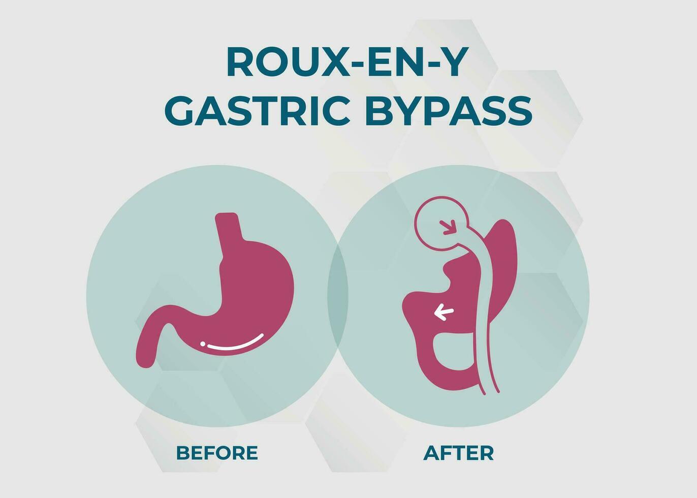 gastrique contourne rny poids perte chirurgie vecteur illustration icône roux-en-y