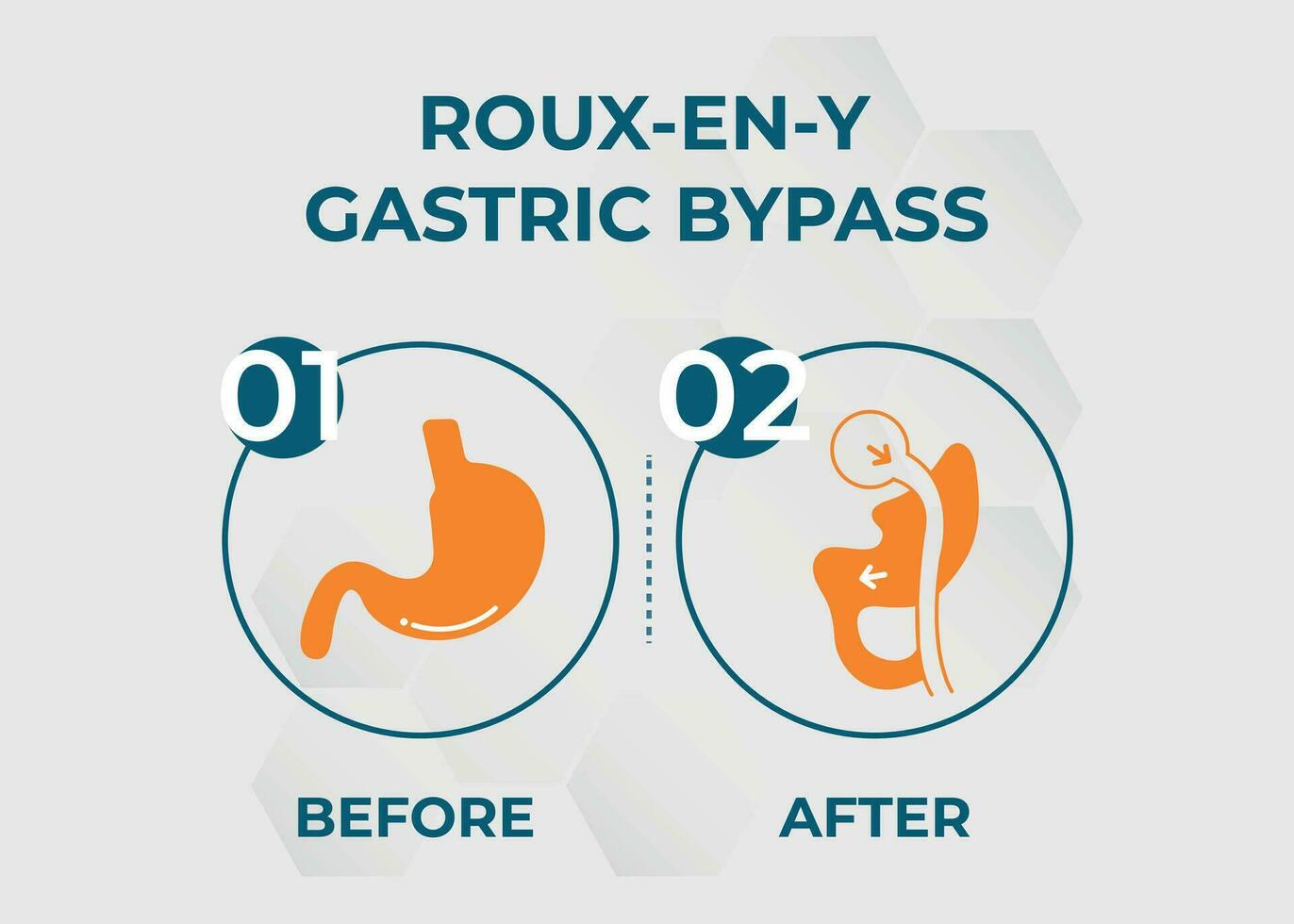 gastrique contourne rny poids perte chirurgie vecteur illustration icône roux-en-y