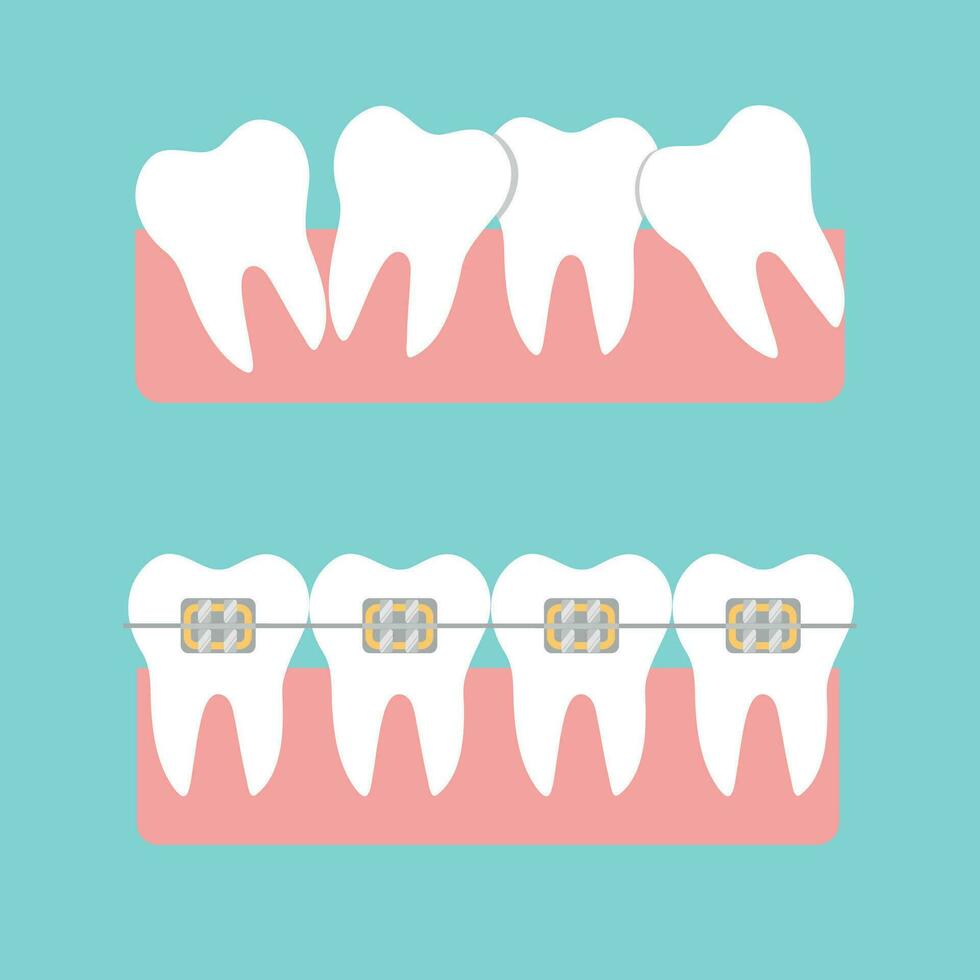 un appareil dentaire courbé dents, tout droit les dents avec un appareil dentaire vecteur