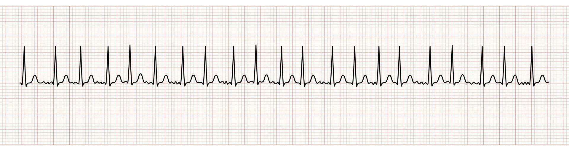 ekg moniteur montrant un procès fibrillation avec rapide ventriculaire réponse vecteur