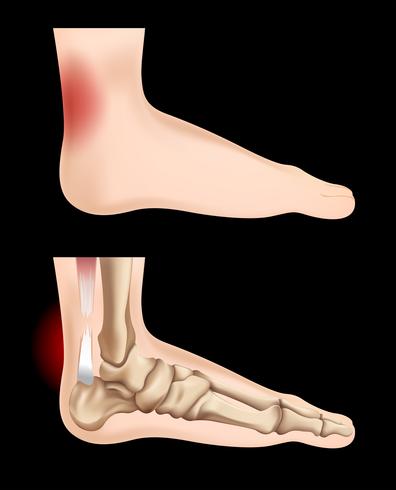 Diagramme montrant une blessure au tendon vecteur