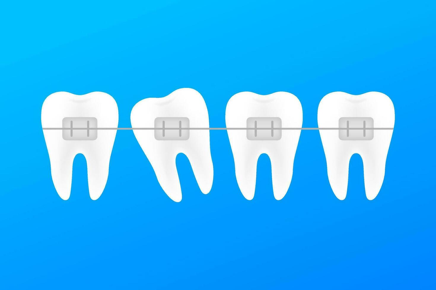 correction de les dents avec orthodontique croisillons. étapes de les dents alignement. dentaire clinique prestations de service. vecteur Stock illustration.