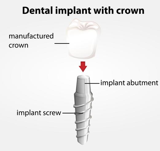 Implant dentaire avec couronne vecteur